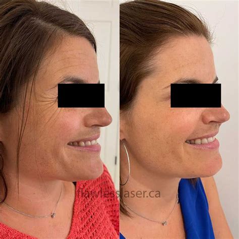 Venus Viva – Flawless Laser and Body Sculpting.